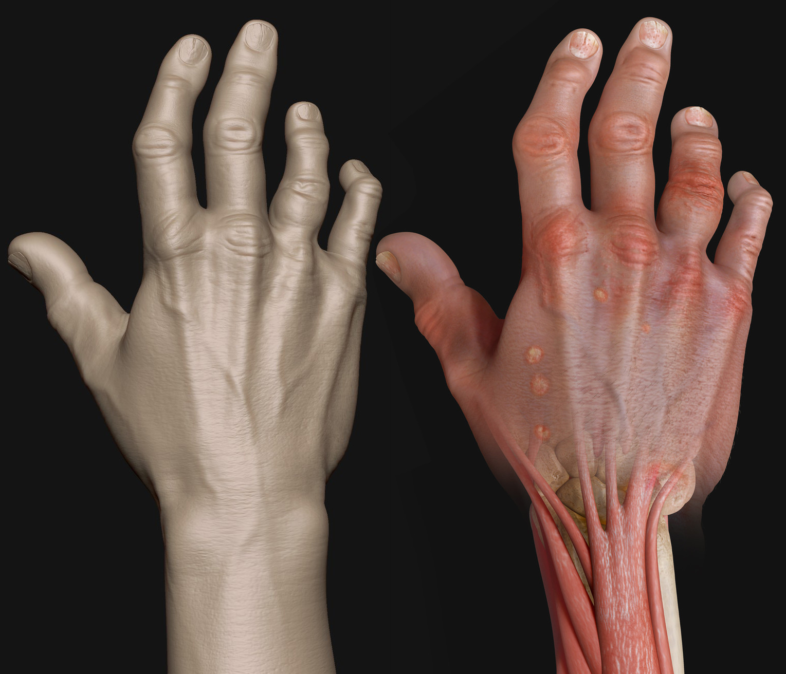 Artstation Psoriatic Arthritis And Hand Studies Eric Pochat - 