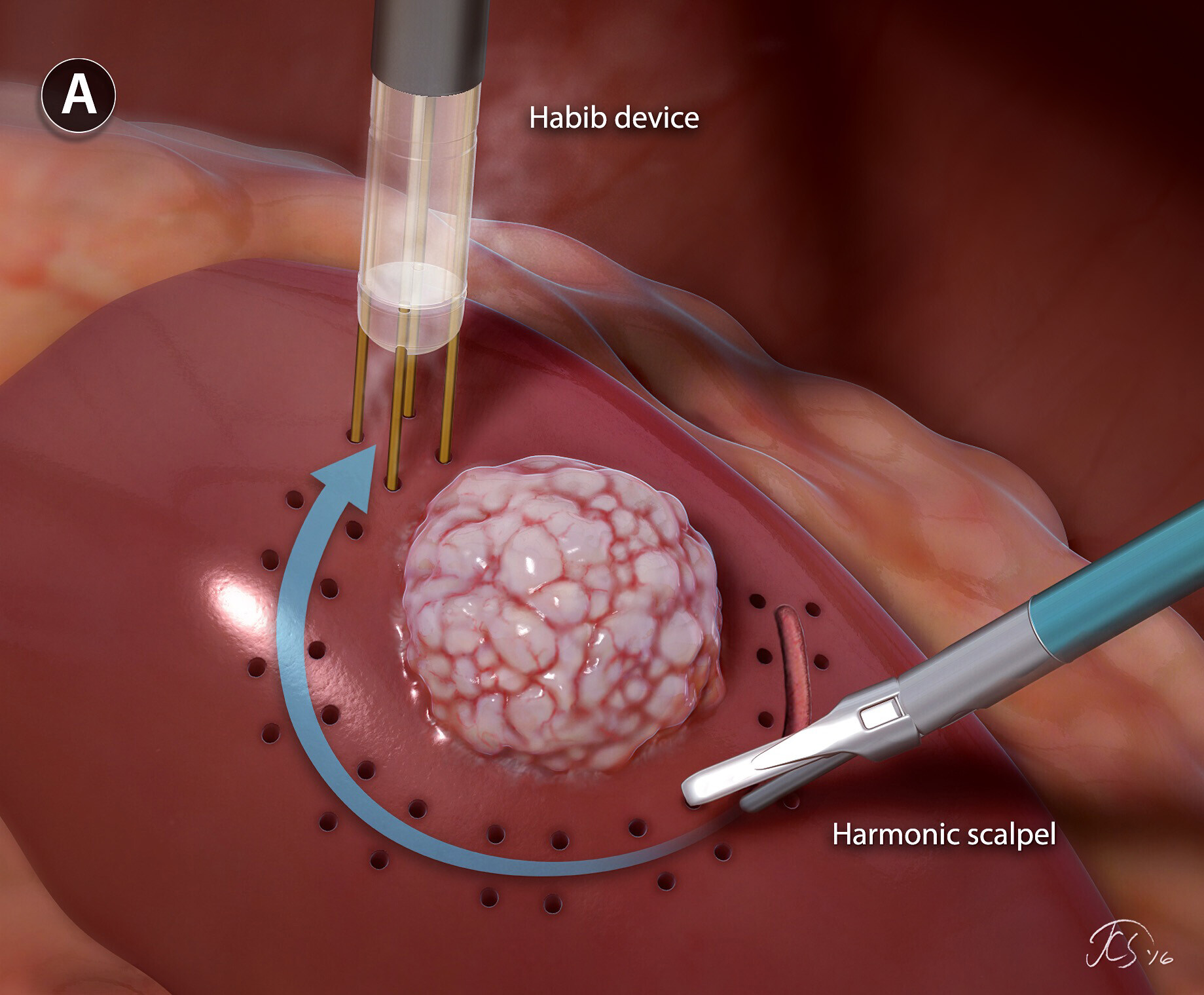 Post Op Care For Partial Nephrectomy