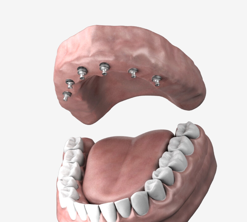 Medical / Dental 3D Animation - Aicrovision