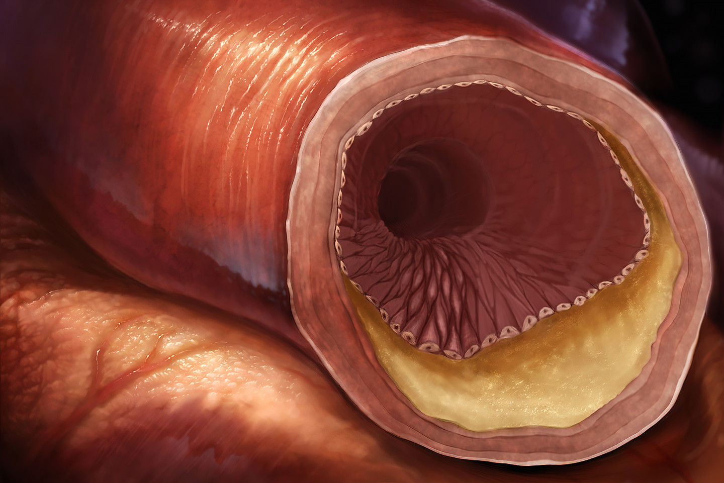 Cholesterol buildup in artery concept