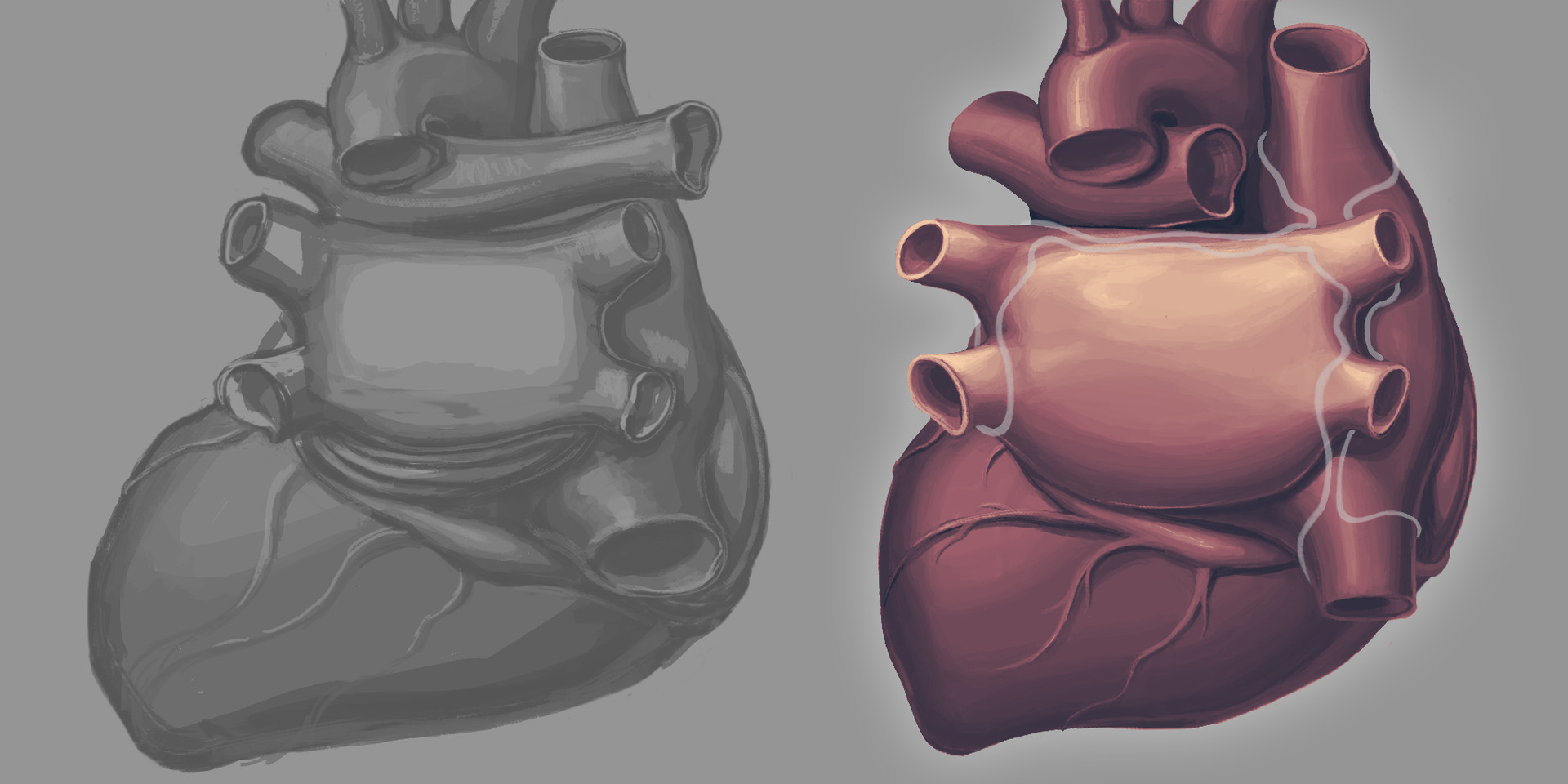 Cleveland Mosher Heart Surgery Medical Illustration