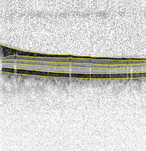 the first scan from an OCT report with the marked segmentation