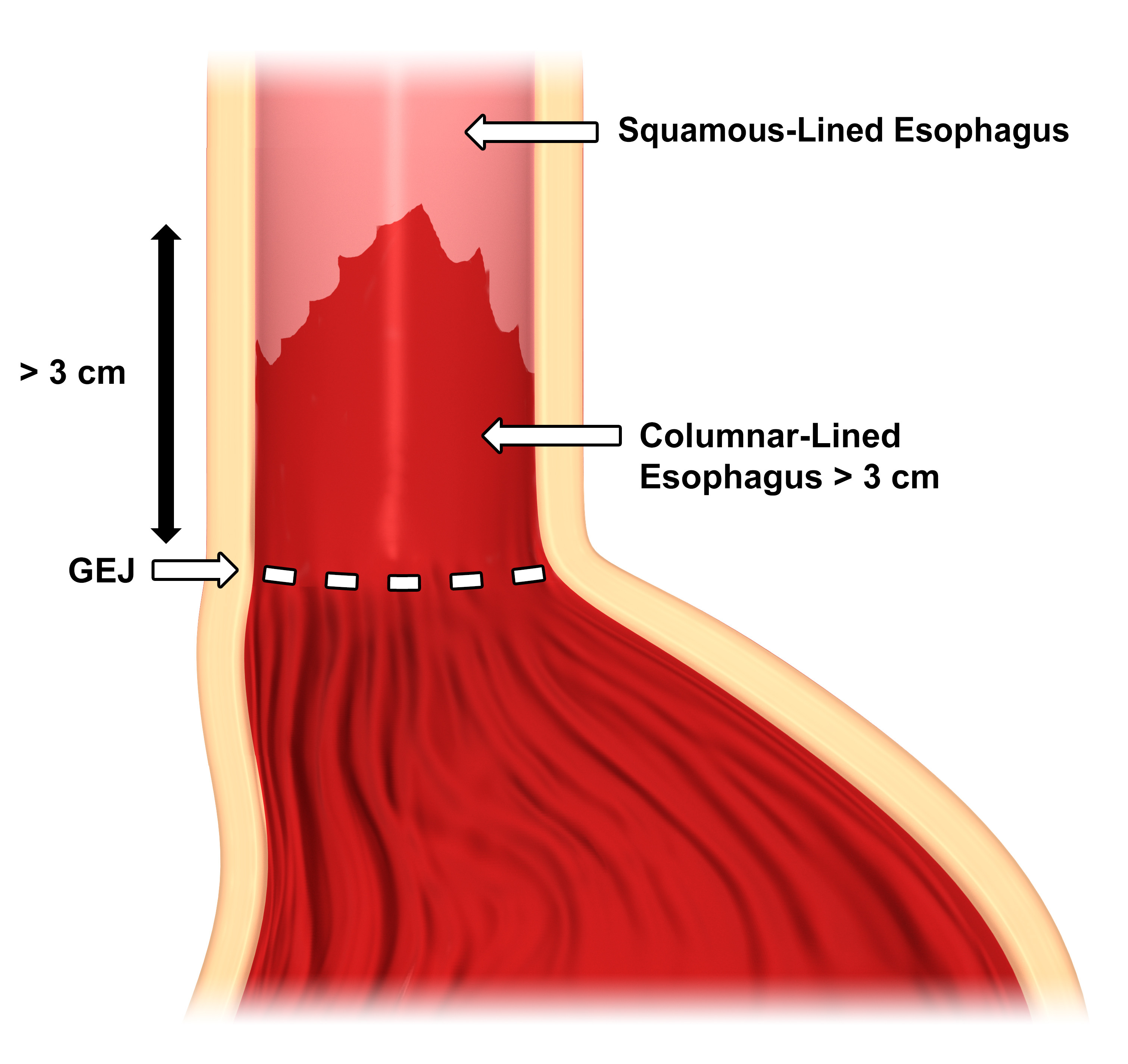 Donald Backos Artstation Portfolio Barrett's Esophagus Diagrams