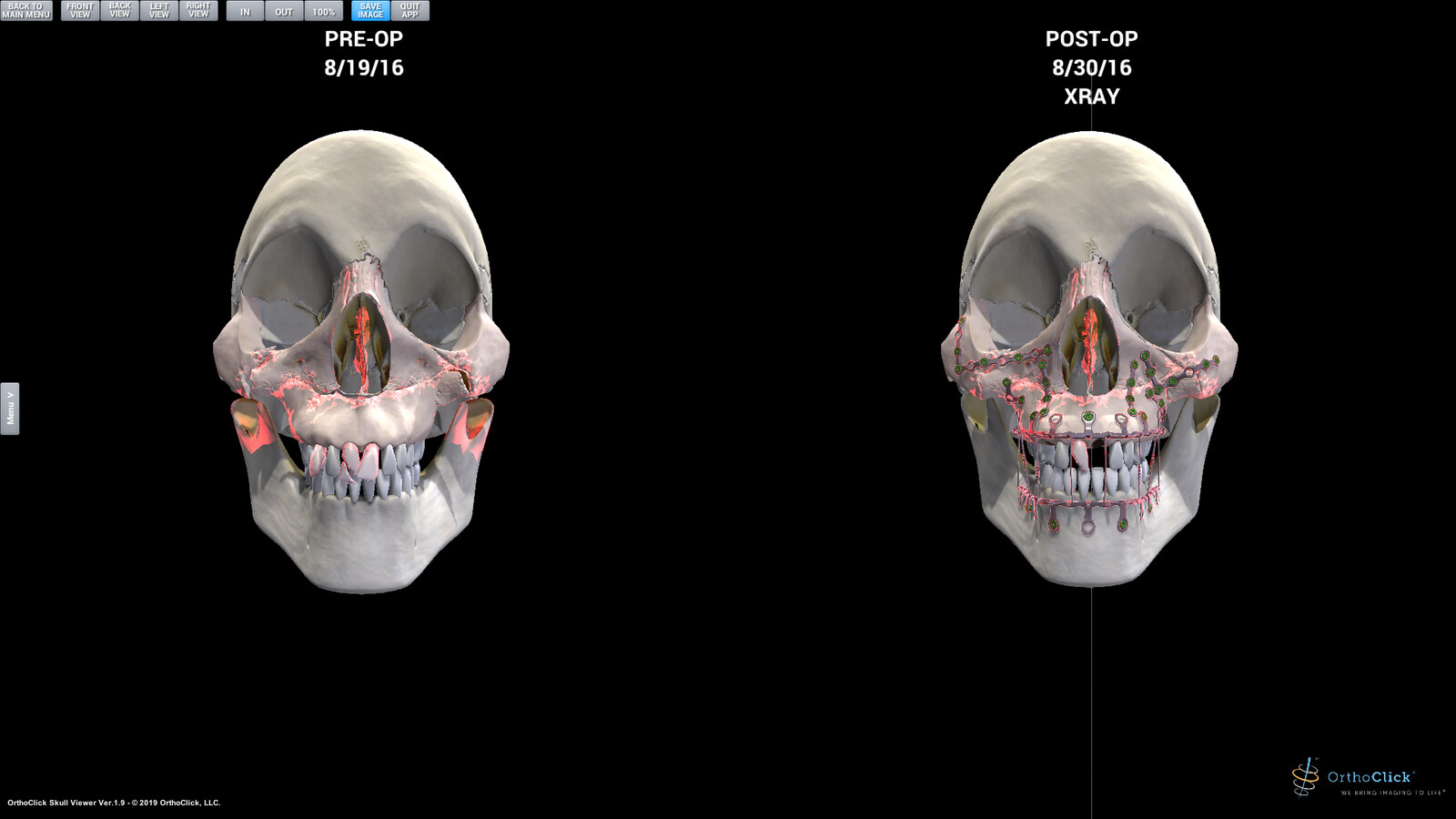 Showing facial fracture before &amp; after surgery side-by-side.