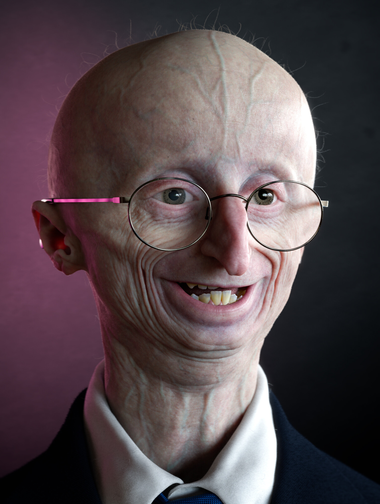progeria sam berns