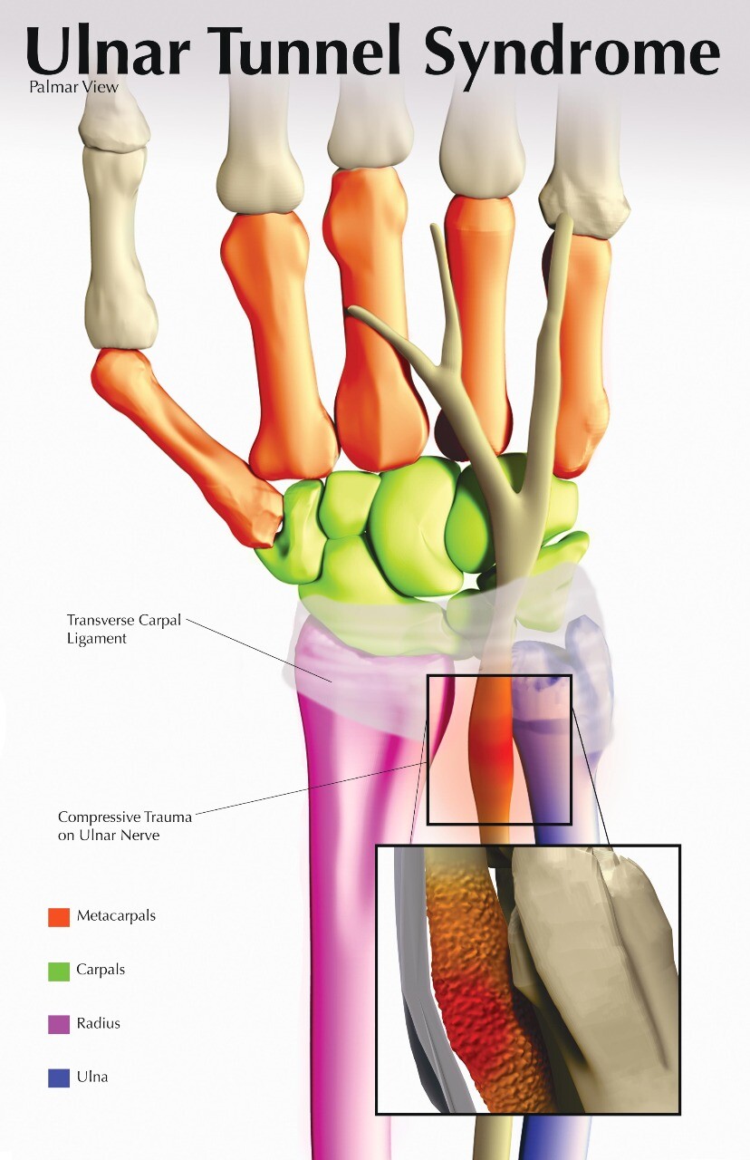 ArtStation - Ulnar Tunnel Syndrome