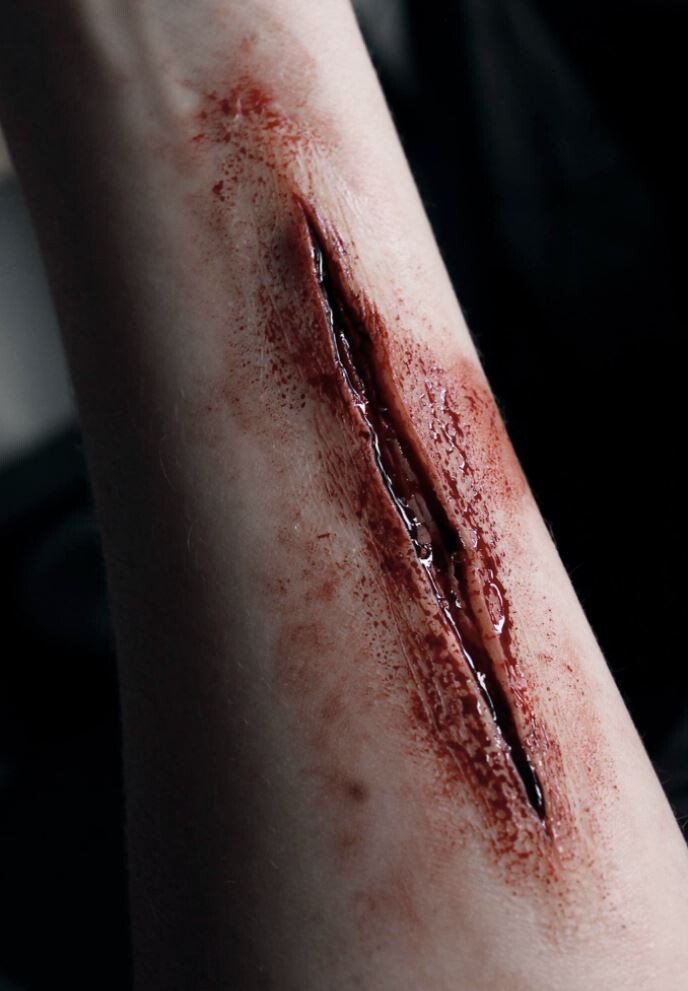 Wound