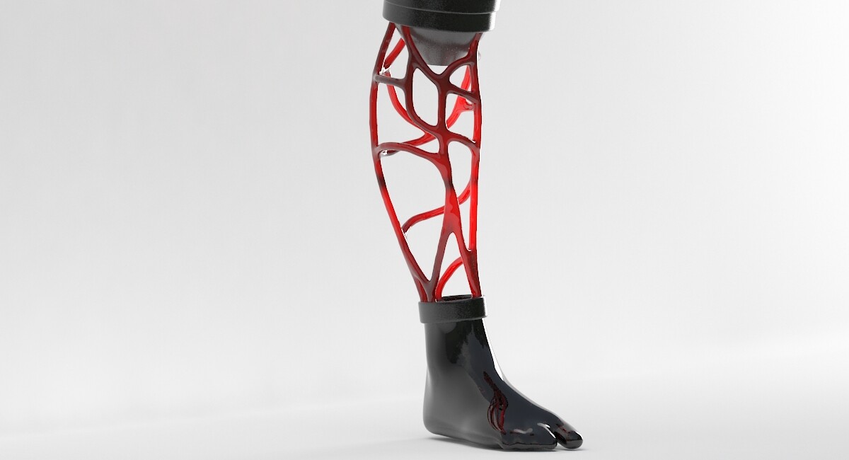 Martyna M personalized covers for shank prosthesis