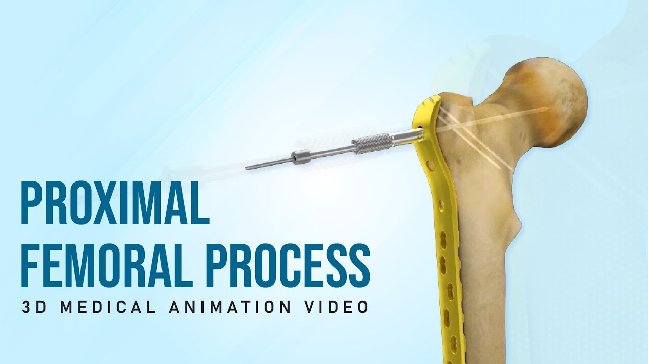 Proximal Femoral Process - 3D Medical Animation Video