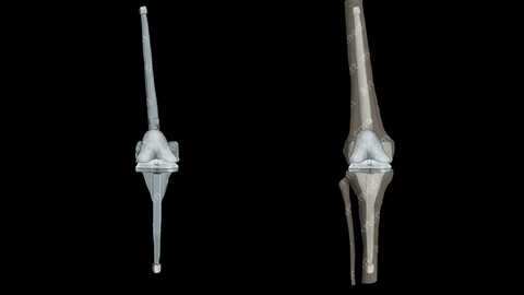 Knee Prosthesis Link Anterior (Anterior)