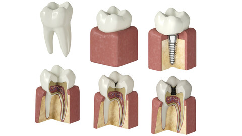 Tooth decay stages cavity caries